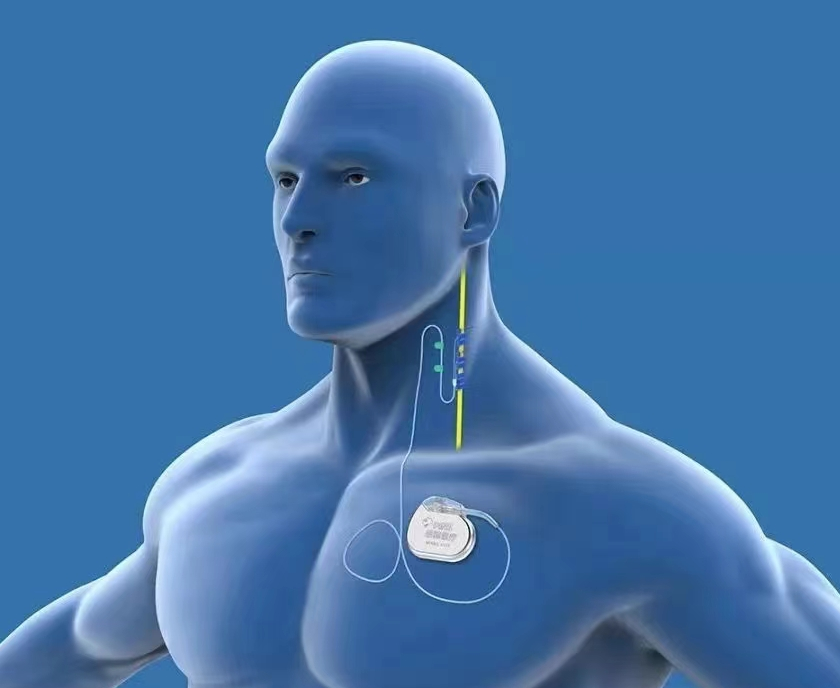 经颅电刺激系列之迷走神经刺激（VNS） - 回映电子科技